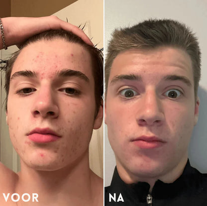 Pori-Clean | Weg met je mee-eters